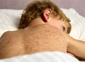 MeaslesBoy lead89 aspect ratio 480 352